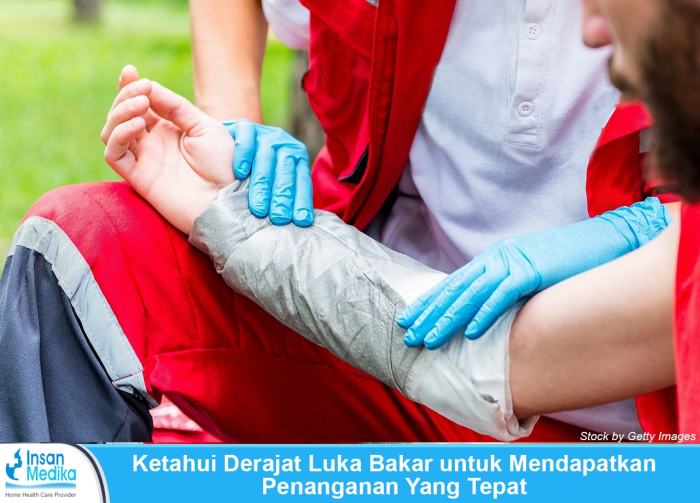 luka pertama bakar pertolongan aspal